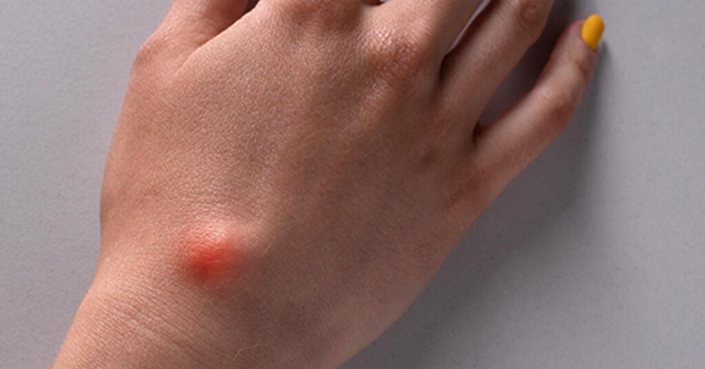 Sarcoma tem cura? Entenda os fatos e fatores de risco
