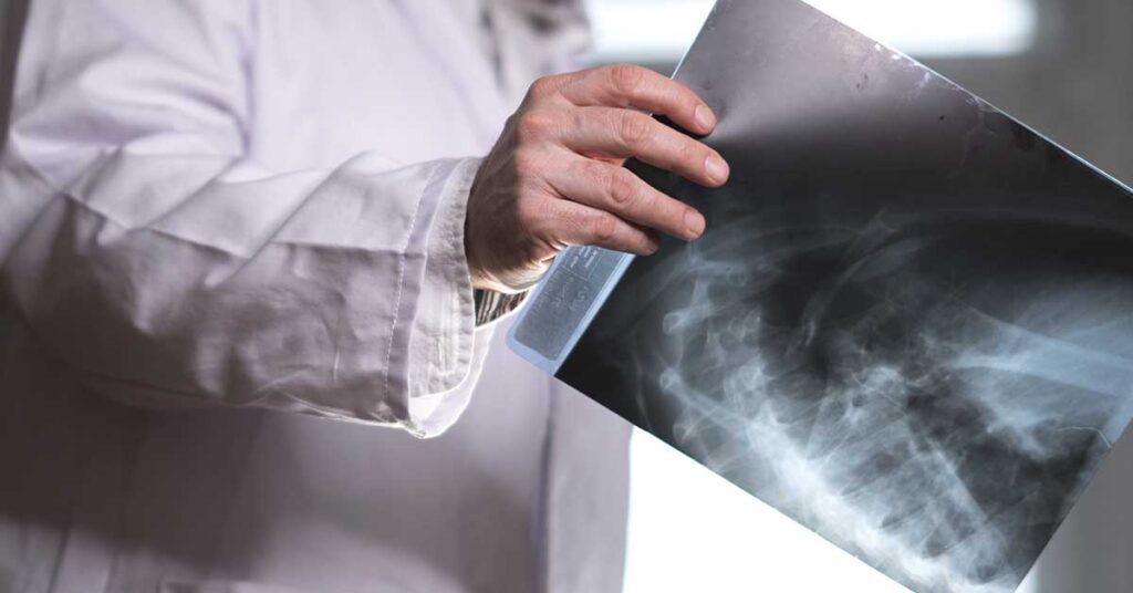 Metástase óssea: diagnóstico, tratamentos modernos e cirurgia ortopédica